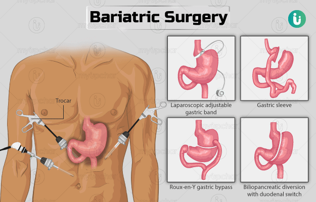 Bariatric Vitamins For Gastric Bypass