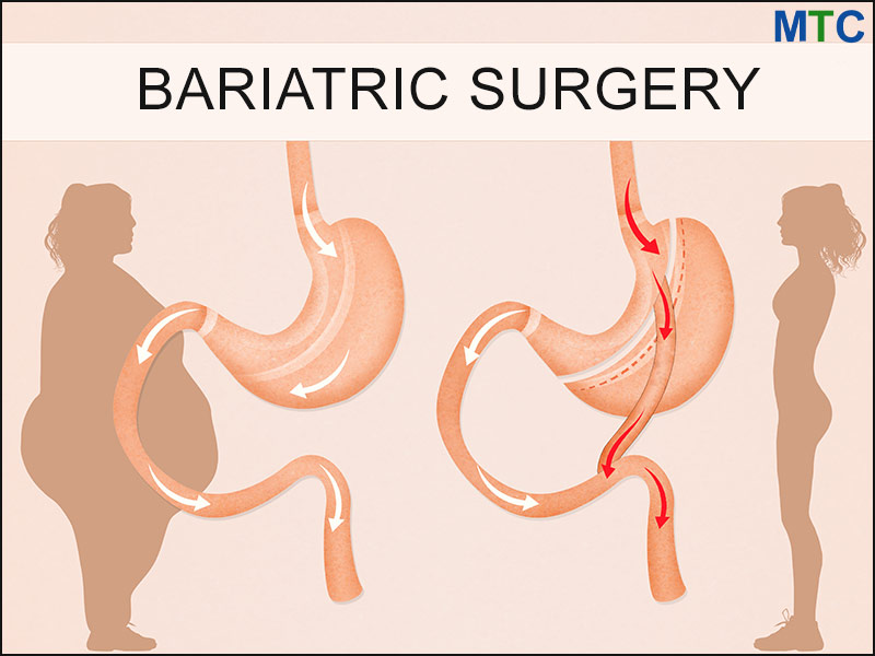 Bariatric Bypass