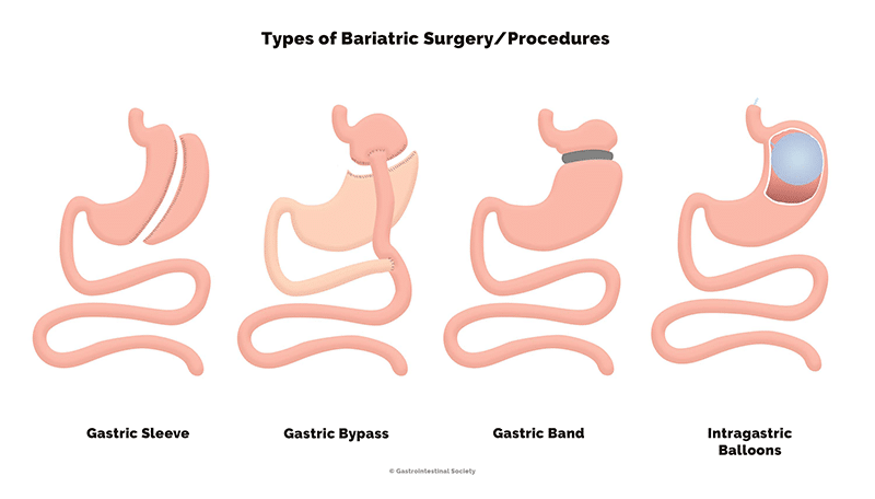 Bariatric Surgery Must Haves 
